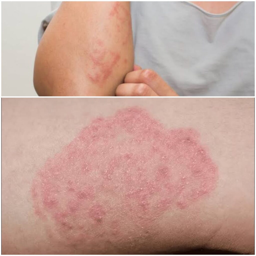 This image has an empty alt attribute; its file name is Skin-Rashes-Fungal-Infections-1024x1024.jpg